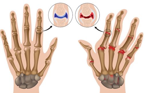 Nexweşiya arthritis û diyardeya wê