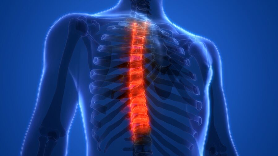 Osteochondrosis stûna sîngê, ku bi hilweşandina dîskên intervertebral ve tête diyar kirin. 