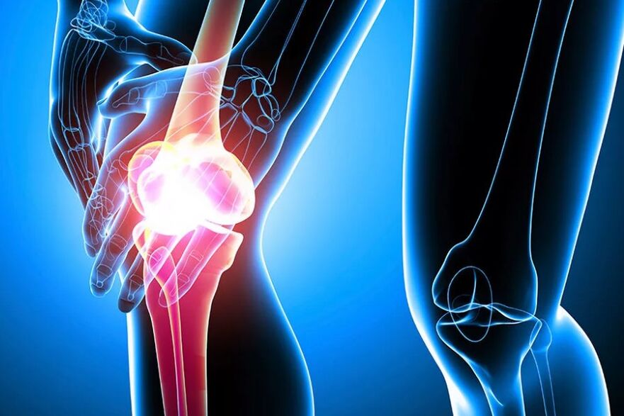 Arthrossis of the kne