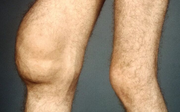 Post -traumatic arthross of the knee hevbeş