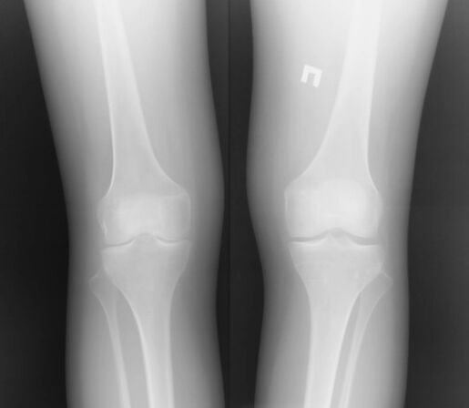 Radiografiya hevbeşiya kokê