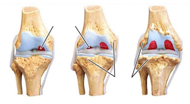 tevlihevî arthross of the niqt