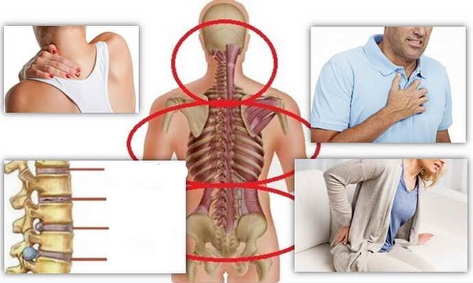 Cihên Nexweşiyê ji bo OsteochondRosis