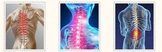 OsteochondRosis Lesions Spinal
