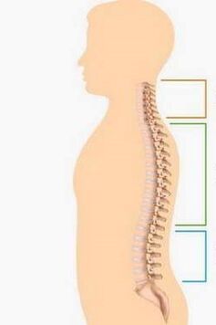 Qesra OsteochondRosis ya perçeyên cihêreng