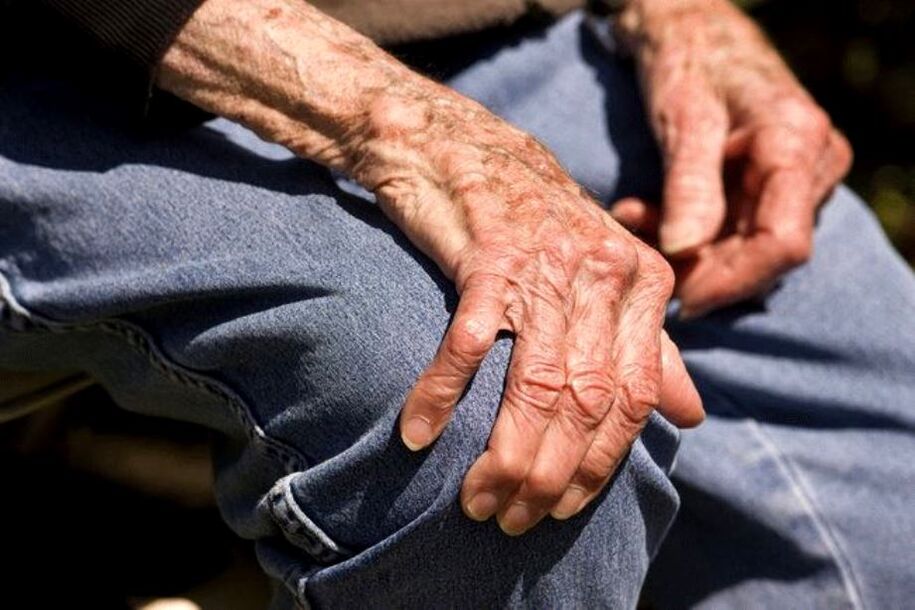 Arthrosis nexweşiyek bi temen e ku di mirovên pîr de pêk tê