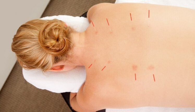 Acupuncture ji bo osteochondrosis thoracic, ku gelek avantajên wê hene