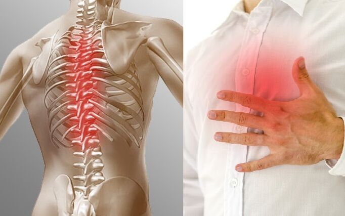 Osteochondrosis toracic bi êş û hestek tengahiyê di sîngê de diyar dibe